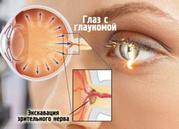 Обнаружена еще одна причина развития катаракты и глаукомы – все о зрении