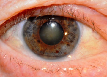 Вторичная катаракта – все о зрении