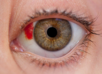 Травмы глаз и способы их лечения – все о зрении