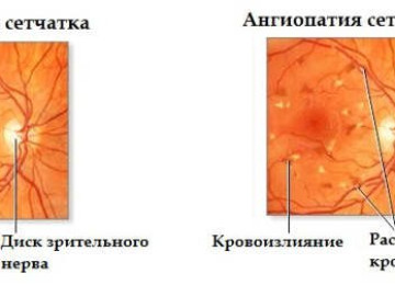Гипертоническая ангиопатия сетчатки – все о зрении