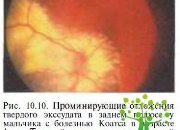 Болезнь коатса (ретинит) – все о зрении