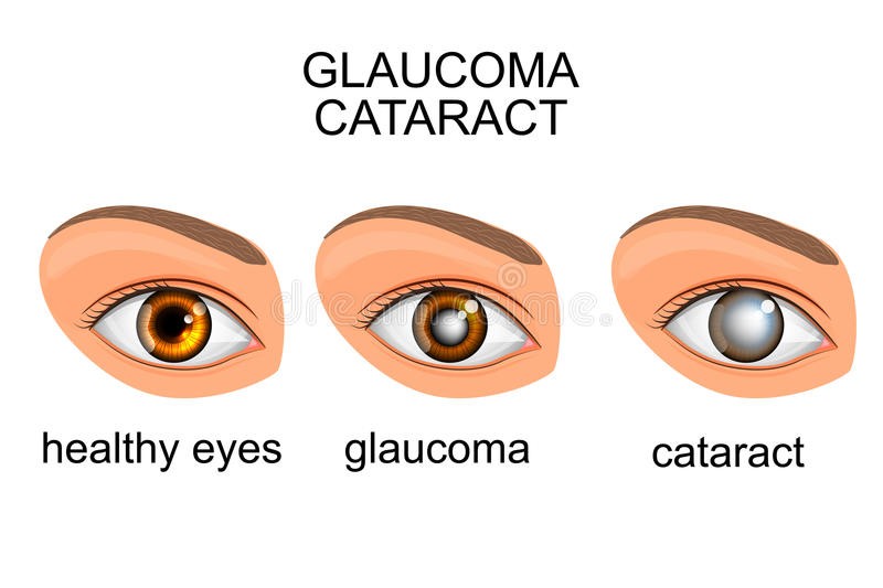 Глаукома и катаракта – все о зрении