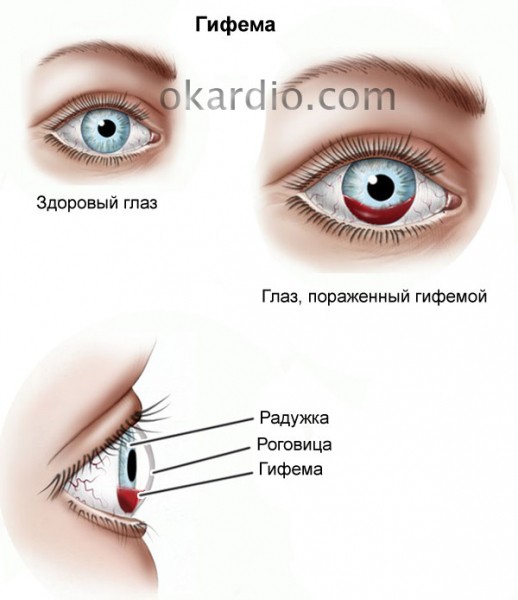 Глазные капли при травме глаз – все о зрении