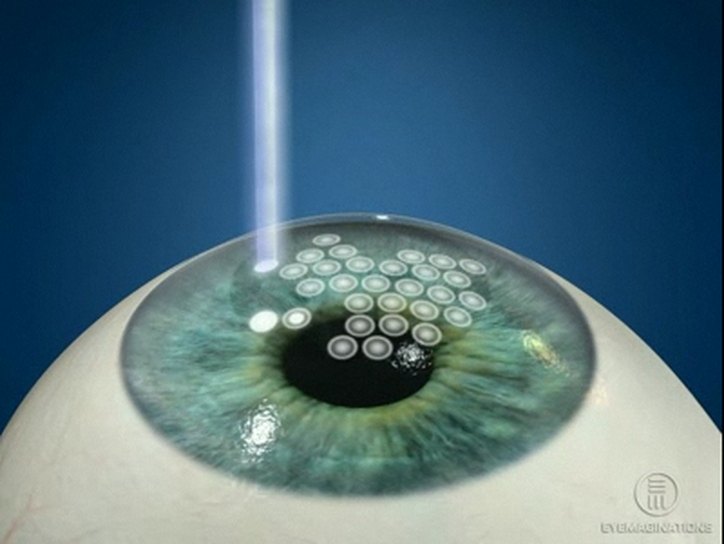 Лазерная коррекция зрения методом фрк – все о зрении