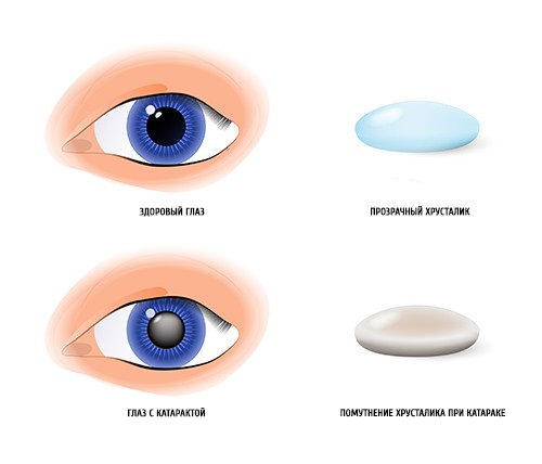 Новая интраокулярная линза поможет в борьбе с глаукомой – все о зрении