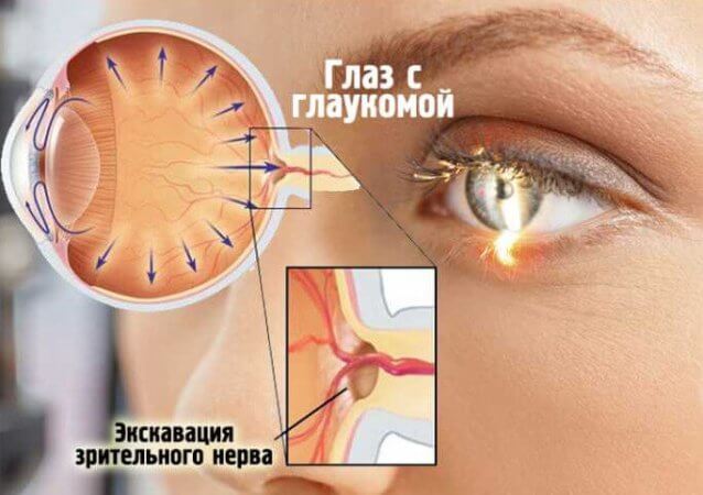 Обнаружена еще одна причина развития катаракты и глаукомы – все о зрении
