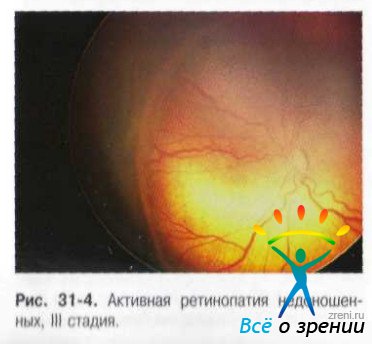 Ретинопатия недоношенных презентация